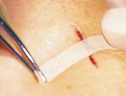 Omnistrip ЛЕНТИЧКИ 3/76мм х 10бр, ХАРТМАН